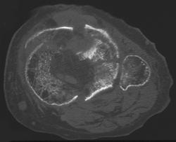 Tibial Plateau Fracture With Osteoporotic Bone - CTisus CT Scan