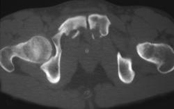 Pelvic Fractures Including Sacrum - CTisus CT Scan