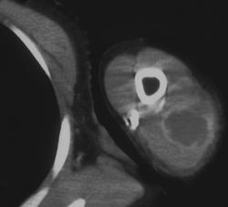 Abscess - CTisus CT Scan