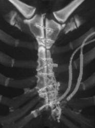 Sternal Nonunion S/P Coronary Artery Bypass - CTisus CT Scan