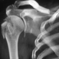 Humerus Fracture - CTisus CT Scan