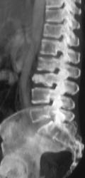 Breast Cancer With Metastases to the Spine - CTisus CT Scan