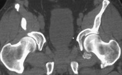 Myositis Ossification - CTisus CT Scan