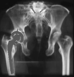 Total Hip Replacement (THR) With Nice 3D With Metal - CTisus CT Scan