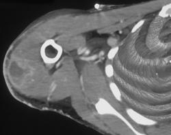 Muscle Abscess - CTisus CT Scan