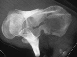 Scapular Fracture - CTisus CT Scan