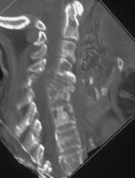 Breast Cancer Metastatic to C-spine - CTisus CT Scan