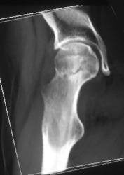 Femur Fracture - CTisus CT Scan