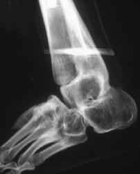 Fusion Ankle Joint - CTisus CT Scan