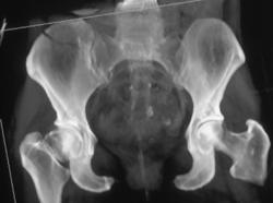 Right Femoral Neck Fracture and Right Iliac Wing Fracture - CTisus CT Scan