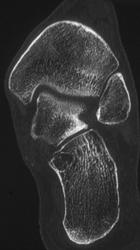 Degenerative Joint Disease (DJD) Ankle Joint - CTisus CT Scan