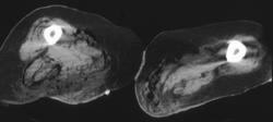 Necrotizing Fasciitis - CTisus CT Scan