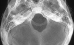 Normal Temporal Bone - CTisus CT Scan