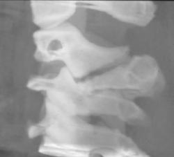 Hangman's Fracture - CTisus CT Scan