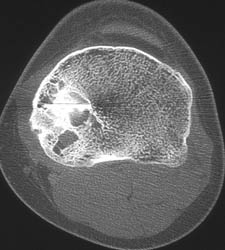 Repair of Prior Bone Cyst With Fracture - CTisus CT Scan
