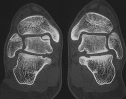 Osteochondritis Dissecans (OCD) - CTisus CT Scan
