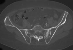 Stress Fracture - CTisus CT Scan