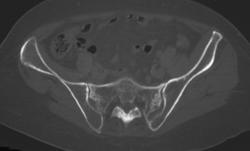 Stress Fracture - CTisus CT Scan