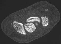 Scaphoid Fracture - CTisus CT Scan