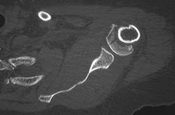 Humerus Fracture - CTisus CT Scan