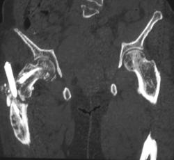 Fractured Femur With Rod in Place - CTisus CT Scan