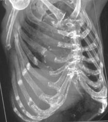 Stress Fractures of Right Sided Ribs - CTisus CT Scan