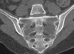 Metastases to Sacrum From Lung Cancer - CTisus CT Scan