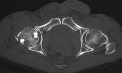 Femur Fracture With Pinning - CTisus CT Scan