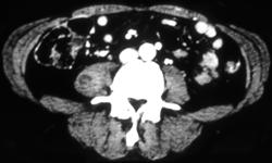 Right Psoas Abscess - CTisus CT Scan