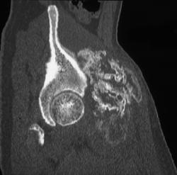 Myositis Ossificans - CTisus CT Scan
