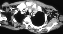 Osteomyelitis Left S/c Joint With Abscess - CTisus CT Scan