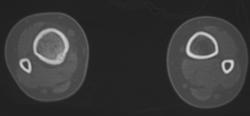 Osteoid Osteoma - CTisus CT Scan