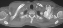 Tumoral Calcinosis - CTisus CT Scan