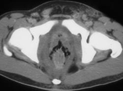 Fournier's Gangrene - CTisus CT Scan