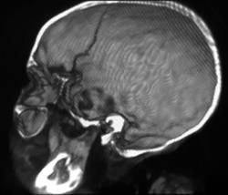 Inca Mummy With Skull Fracture - CTisus CT Scan