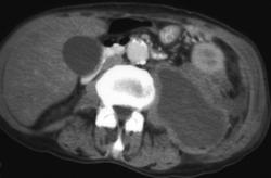 Left Psoas Abscess - CTisus CT Scan
