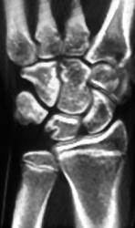 3D of Carpal Bones - CTisus CT Scan