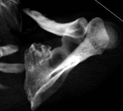 Exostosis Scapula - CTisus CT Scan