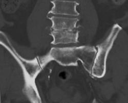 Osteomyelitis L4-5 - CTisus CT Scan