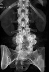 Laminectomy With  Attempted Fusion - CTisus CT Scan