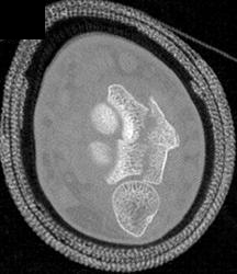 Radius Fracture - CTisus CT Scan