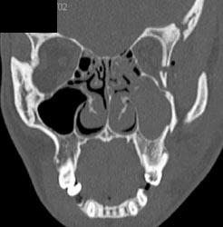 Orbital Fracture - CTisus CT Scan
