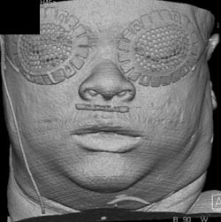 GSW Orbit - CTisus CT Scan