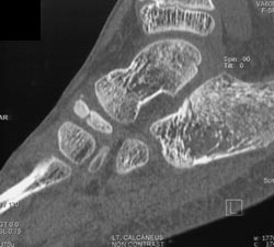 Calcaneal Fracture - CTisus CT Scan