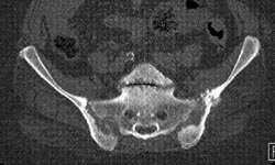 Erosion of SI Joints Due to Secondary Hyperparathyroidism - CTisus CT Scan