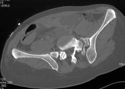 Sacral Fracture - CTisus CT Scan