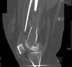 Femur Fracture - CTisus CT Scan