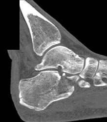 Calcaneal Fracture - CTisus CT Scan