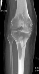 Metastatic Lung Cancer With A Fracture - CTisus CT Scan