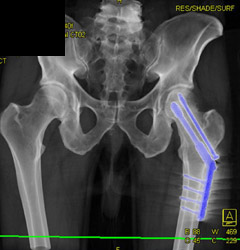 Hip Pinning for Femur Fracture - CTisus CT Scan